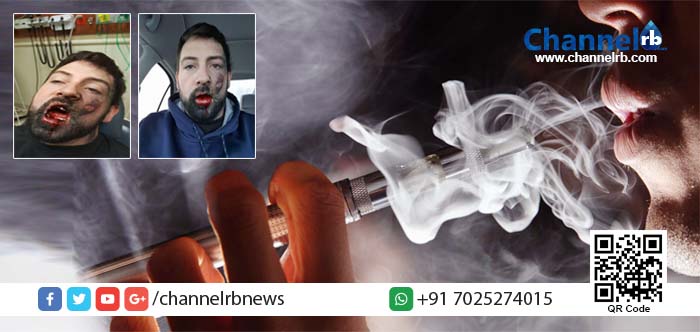 You are currently viewing ഇ- സിഗരറ്റ് പൊട്ടിത്തെറിച്ച് യുവാവിന്റെ ഏഴു പല്ലുകള്‍ നഷ്ടപ്പെട്ടു.