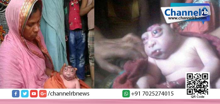 You are currently viewing അപൂര്‍വ ജനിതക വൈകല്യവുമായി ഒരു കുഞ്ഞ്: ഹനുമാന്റെ അവതാരമെന്ന് നാട്ടുകാര്‍.