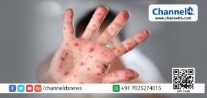 Read more about the article അഞ്ചാം പനി സംസ്ഥാനത്ത് വ്യാപകമാകുന്നു; പൊതുജനങ്ങള്‍ ജാഗ്രതപാലിക്കാന്‍ ആരോഗ്യവകുപ്പിന്റെ നിര്‍ദേശം