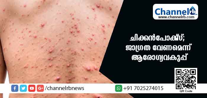 You are currently viewing കാസര്‍കോട് ജില്ലയില്‍ ചിക്കന്‍പോക്സ് വരുന്നു; ജാഗ്രത വേണമെന്ന് ആരോഗ്യവകുപ്പ്