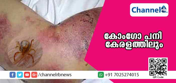 You are currently viewing നിപ്പയ്ക്ക് പിന്നാലെ കോംഗോ പനി കേരളത്തിലും: മലപ്പുറം സ്വദേശി തൃശൂരില്‍ ചികിത്സയില്‍