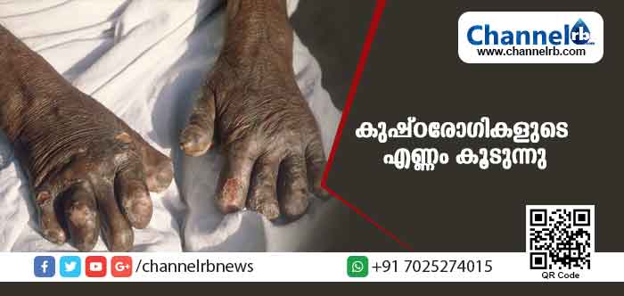 Read more about the article കുഷ്ഠരോഗികളുടെ എണ്ണം സംസ്ഥാനത്ത് കൂടുന്നതായി പുതിയ റിപ്പോർട്ട്; കുട്ടികളടക്കം 140 പേര്‍ക്കുകൂടി രോഗം സ്ഥിരീകരിച്ചു; പരിശോധന നടത്തിയ എട്ട് ജില്ലകൾ