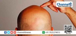 Read more about the article ’കഷണ്ടിക്കാരുടെ അന്താരാഷ്ട്ര ദിനം’ യാഥാര്‍ത്ഥ്യമാകുമോ?; ആവശ്യവുമായി ഐക്യരാഷ്ട്ര സഭയെ സമീപിക്കാന്‍ മലപ്പുറത്തെ കഷണ്ടിക്കാര്‍