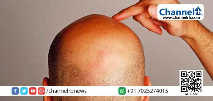 Read more about the article ’കഷണ്ടിക്കാരുടെ അന്താരാഷ്ട്ര ദിനം’ യാഥാര്‍ത്ഥ്യമാകുമോ?; ആവശ്യവുമായി ഐക്യരാഷ്ട്ര സഭയെ സമീപിക്കാന്‍ മലപ്പുറത്തെ കഷണ്ടിക്കാര്‍