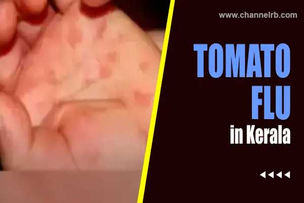 You are currently viewing സ്കൂ​ളു​ക​ള്‍ തു​റ​ക്കാ​നി​രി​ക്കെ ത​ക്കാ​ളിപ്പ​നി പ​ട​രു​ന്ന​ത് ആ​ശ​ങ്ക; അ​തീ​വ             ഗൗ​ര​വ​ത്തോ​ടെ​ ആ​രോ​ഗ്യ​വ​കു​പ്പ്, മു​തി​ര്‍​ന്ന​വ​ര്‍​ക്കും രോ​ഗം വ​രാം​