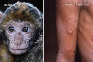 Read more about the article കേരളത്തില്‍ കുരങ്ങു വസൂരിയെന്ന് സംശയം; സംസ്ഥാനങ്ങള്‍ക്ക് ജാഗ്രതാ നിര്‍ദേശം നല്‍കി കേന്ദ്ര ആരോഗ്യ മന്ത്രാലയം