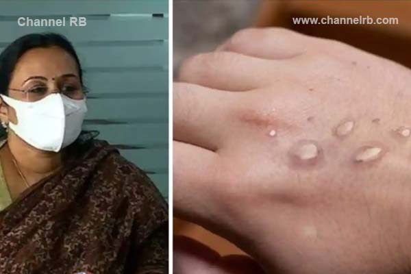 Read more about the article മങ്കിപോക്‌സ് സ്ഥിരീകരണം; രാജ്യത്തെ ആദ്യമരണം, 20പേര്‍ സമ്പര്‍ക്ക പട്ടികയില്‍, വിമാന യാത്രികരടക്കം നിരവധി സമ്പർക്കം ഉണ്ടാകാമെന്നും ജാഗ്രത മതിയെന്നും  ആരോഗ്യമന്ത്രി
