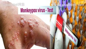 Read more about the article കാസർകോട് സ്വദേശിക്ക് മങ്കിപോക്‌സ് സ്ഥിരീകരിച്ചു; യുഎഇയിൽ നിന്നെത്തിയ 37കാരനാണ് രോഗം സ്ഥിരീകരിച്ചത്