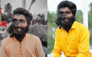 Read more about the article മുഖത്തും ശരീരത്തും വളര്‍ന്നുകൊണ്ടിരിക്കുന്ന കറുത്ത മറുക് തൊലിയെ ബാധിച്ച ക്യാന്‍സർ; പ്രഭുലാല്‍ പ്രസന്നന്‍ മരണത്തിന് കീഴടങ്ങി