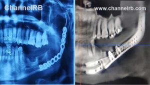 Read more about the article കോട്ടയം മെഡിക്കല്‍ കോളജില്‍ അപൂര്‍വ ശസ്ത്രക്രിയ വിജയം; രോഗി സുഖം പ്രാപിച്ചുവരുന്നു