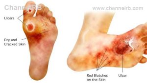 Read more about the article ഷാര്‍ക്കോട്ട് ഫൂട്ട് രോഗം കേരളത്തില്‍ വര്‍ധിക്കുന്നു; പ്രമേഹ രോഗികളില്‍ 7.5 % പേര്‍ക്ക് രോഗ സാധ്യത, ബോധവത്കരണം വേണം