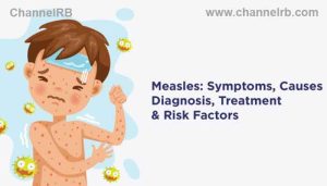 Read more about the article അഞ്ചാംപനിയെ സൂക്ഷിക്കുക; പനി, ചുമ, കണ്ണ് ചുവക്കല്‍, ജലദോഷം, ആരോഗ്യ വകുപ്പ് മുന്നറിയിപ്പ്, ചികിത്സിച്ചില്ലെങ്കില്‍ നിര്‍ജ്ജലീകരണം മൂലം മരണം സംഭവിക്കാം