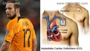 Read more about the article മൈതാനത്ത് രണ്ടുതവണ ഹൃദയാഘാതം; ഡച്ച്‌ താരം ഡിഫ്രിബിലേറ്റര്‍ ഘടിപ്പിച്ച്‌ അര്‍ജന്‍റീനയെ നേരിടും