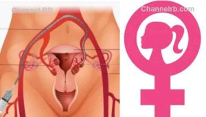 Read more about the article ഗര്‍ഭാശയ മുഴകളെ ഭയക്കേണ്ടതില്ല; കാൻസര്‍ അല്ലാത്ത മുഴകളാണ് ഫൈബ്രോയിഡുകള്‍, ശസ്ത്രക്രിയ ഇല്ലാതെ ചികിത്സിക്കാം