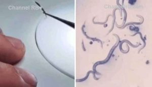 Read more about the article സ്ഥിരമായി നഖം കടിക്കുന്നവര്‍ക്ക് ഭീഷണിയാകും ഈ വിരകള്‍; ഭീതിയുണ്ടാക്കുന്ന ചിത്രങ്ങൾ വൈറല്‍