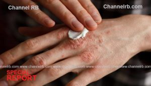 Read more about the article സോറിയാസിസ് പകരില്ല; ചികിത്സ വേണം, കാലാവസ്ഥയിലെ മാറ്റം, മറ്റേതെങ്കിലും അണുബാധ, മാനസിക സമ്മര്‍ദം, ശാരീരിക സമ്മര്‍ദം ശ്രദ്ധിക്കണം