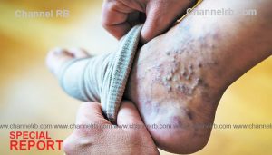 Read more about the article വെരിക്കോസ് വെയിൻ അപകടം; ലക്ഷണങ്ങളും സങ്കീര്‍ണതകളും അറിയാം