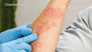 Read more about the article വേനൽ ചൂട് പിടിമുറുക്കുന്നു; ഒപ്പം രോഗങ്ങളും, ചി​ക്ക​ൻ​ ​പോ​ക്‌​സിൻ്റെ വ്യാപനവും സംസ്ഥാനത്ത് കൂടുതലായി, ജാഗ്രത പാലിക്കണമെന്ന് ആരോഗ്യ വകുപ്പ്