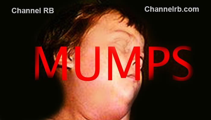 You are currently viewing കുട്ടികളില്‍ മുണ്ടിനീര് പടരുന്നു; ആറ് ദിവസത്തിനിടെ സംസ്ഥാനത്ത് രോഗം ബാധിച്ചത് 1649 പേര്‍ക്ക്‌