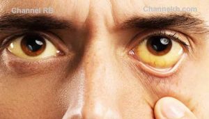 Read more about the article മലപ്പുറത്ത് മഞ്ഞപ്പിത്തം പടരുന്നു; രോഗം ബാധിച്ച് വീണ്ടും ഒരാൾ മരിച്ചു, അഞ്ച് മാസത്തിനിടെ ഒമ്പത് മരണം, പ്രദേശങ്ങളിൽ വ്യാപക ജാഗ്രത നിർദേശം